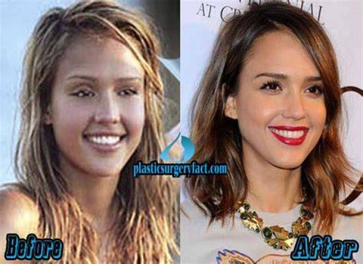 Jessica Alba before and after plastic surgery 45 Celebrity plastic